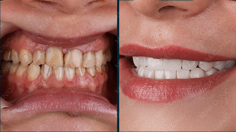 hollywood smile before and after